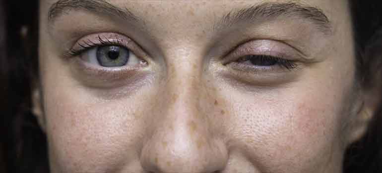 Myasthenia Gravis